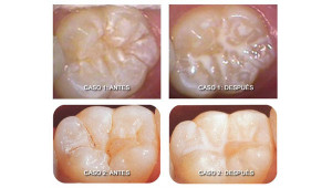materiales_contra_caries